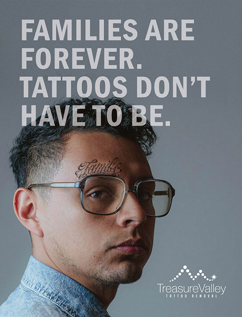 Tattoo Removal | Boise, ID | 208-230-7579