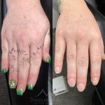 hand tattoo removal
