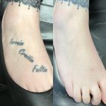 foot tattoo removal