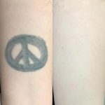 arm tattoo removal