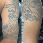 arm tattoo removal