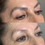 eyebrow tattoo removal