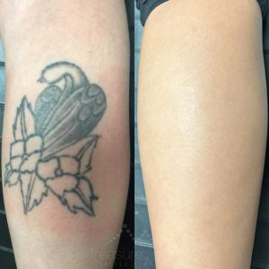 arm tattoo removal