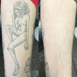 arm tattoo removal