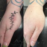 hand tattoo removal