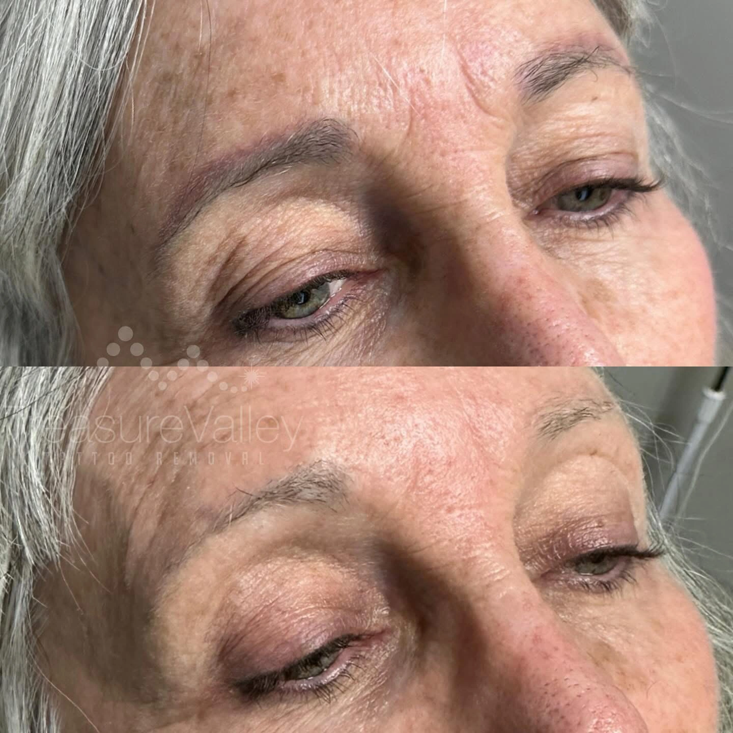 Permanent Cosmetic eyebrow removal Before and after older woman darker eyebrows