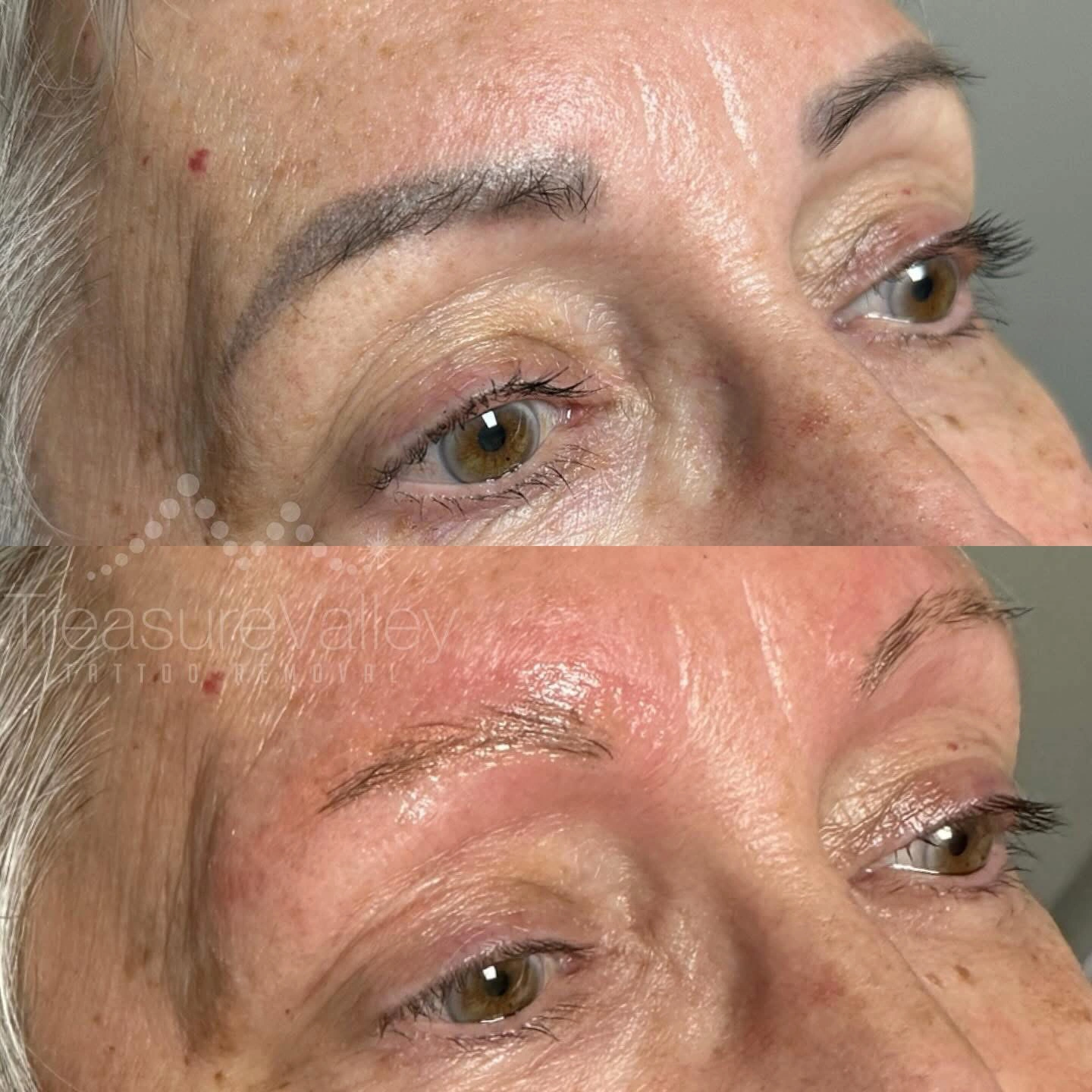 Permanent Cosmetic eyebrow removal Before and after older woman with dark eyebrows