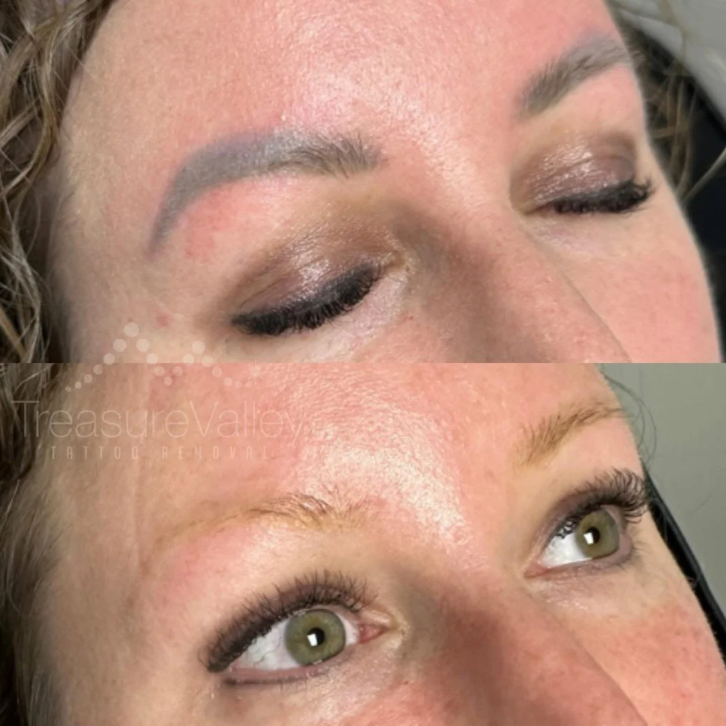 removal of permanent eyebrow makeup
