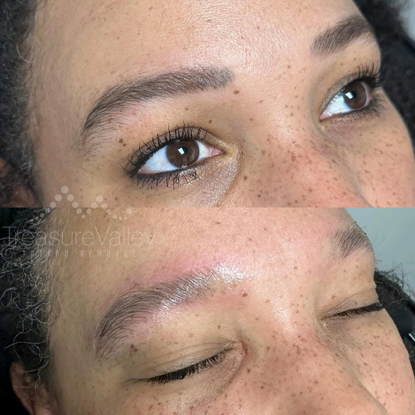 Permanent Cosmetic eyebrow removal Before and after younger woman dark hair brown eyes