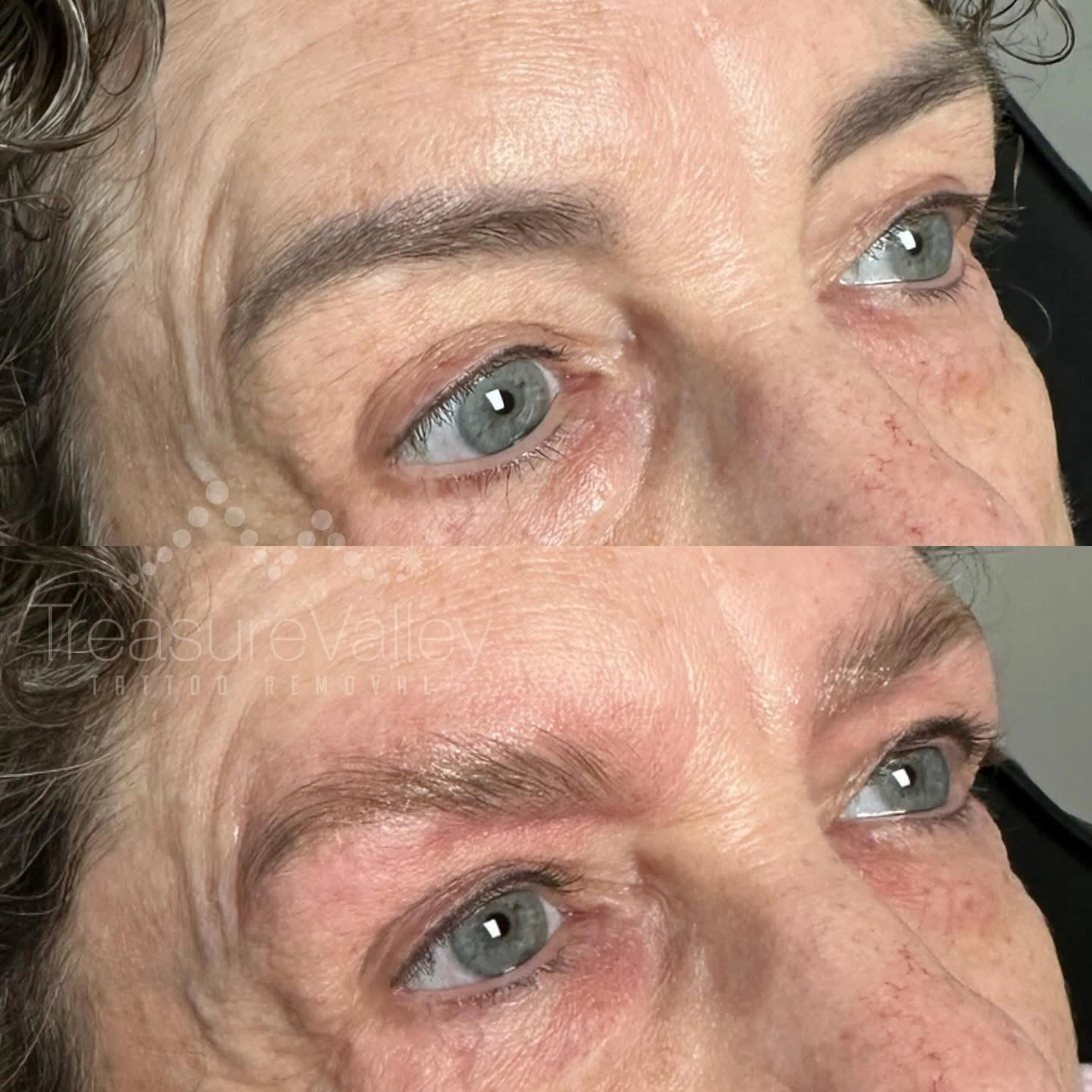 Permanent Cosmetic eyebrow removal Before and after older woman dark hair blue eyes