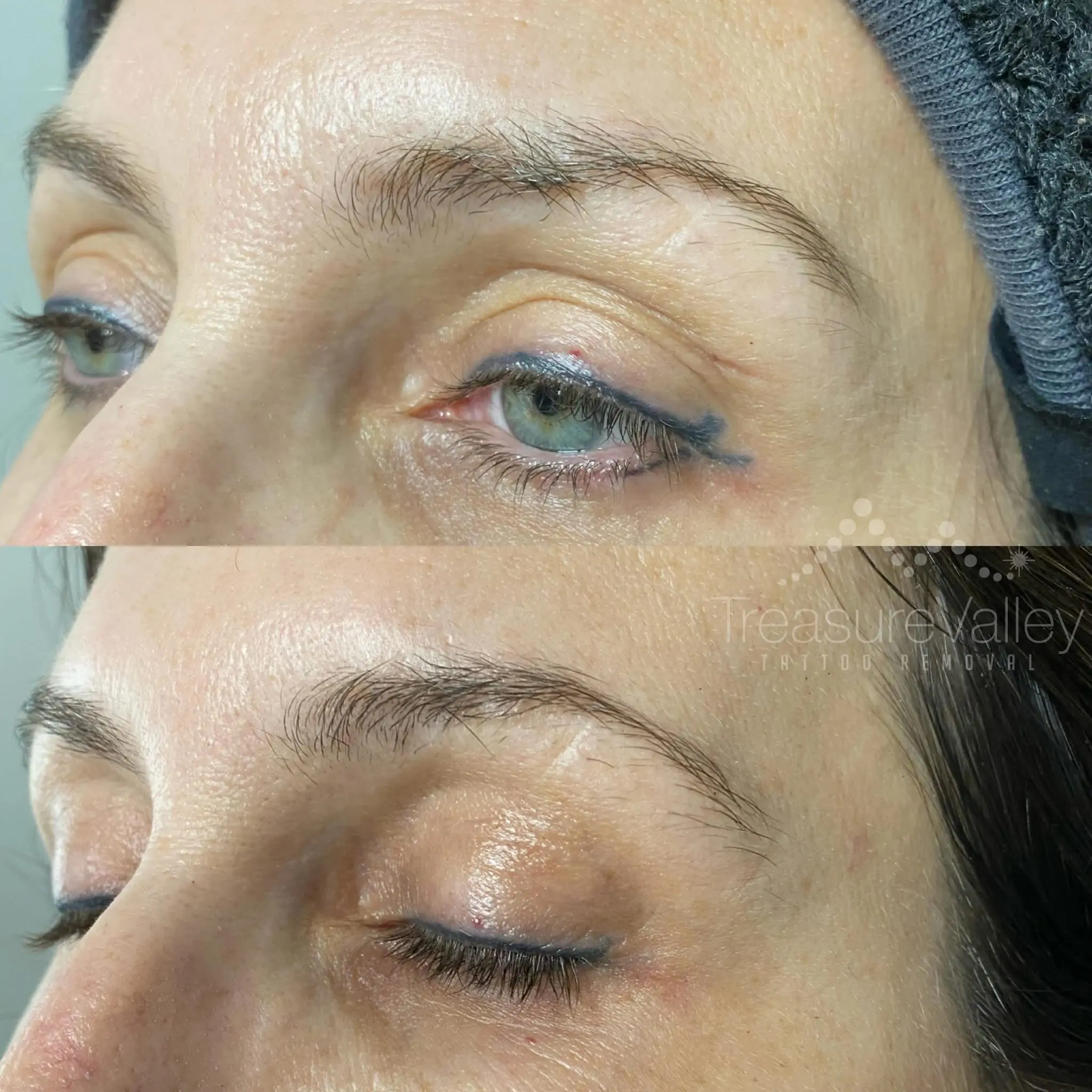 Permanent Cosmetic eyeliner removal Before and after