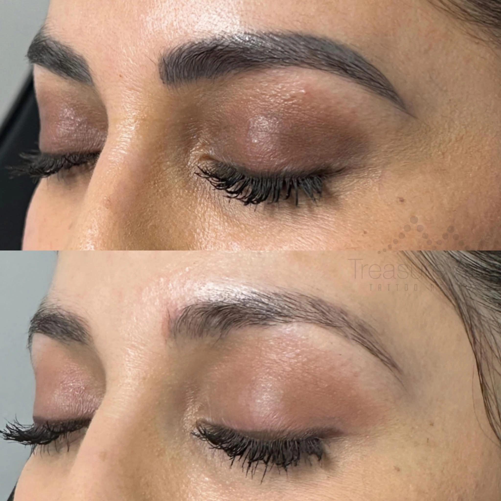 Permanent Cosmetic eyebrow removal Before and after eyes closed