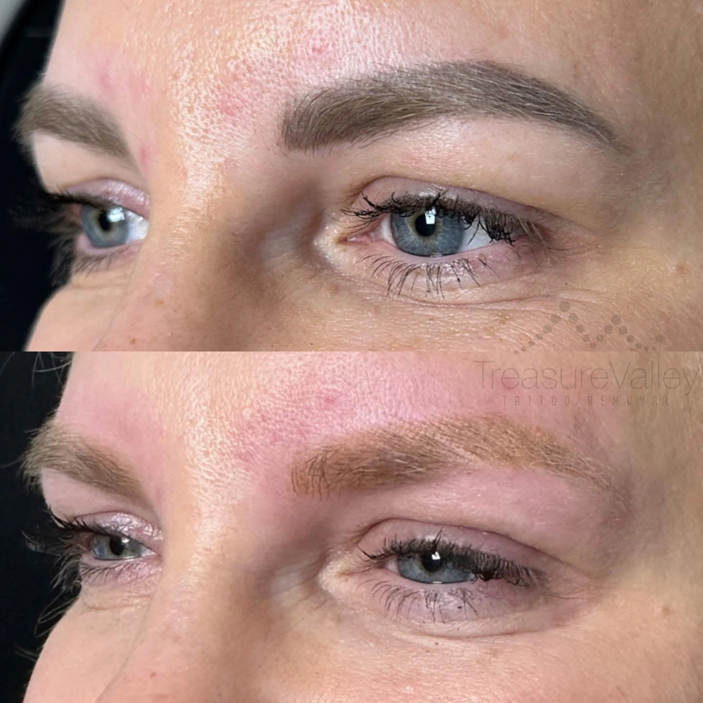 Permanent Cosmetic eyebrow removal Before and after light hair