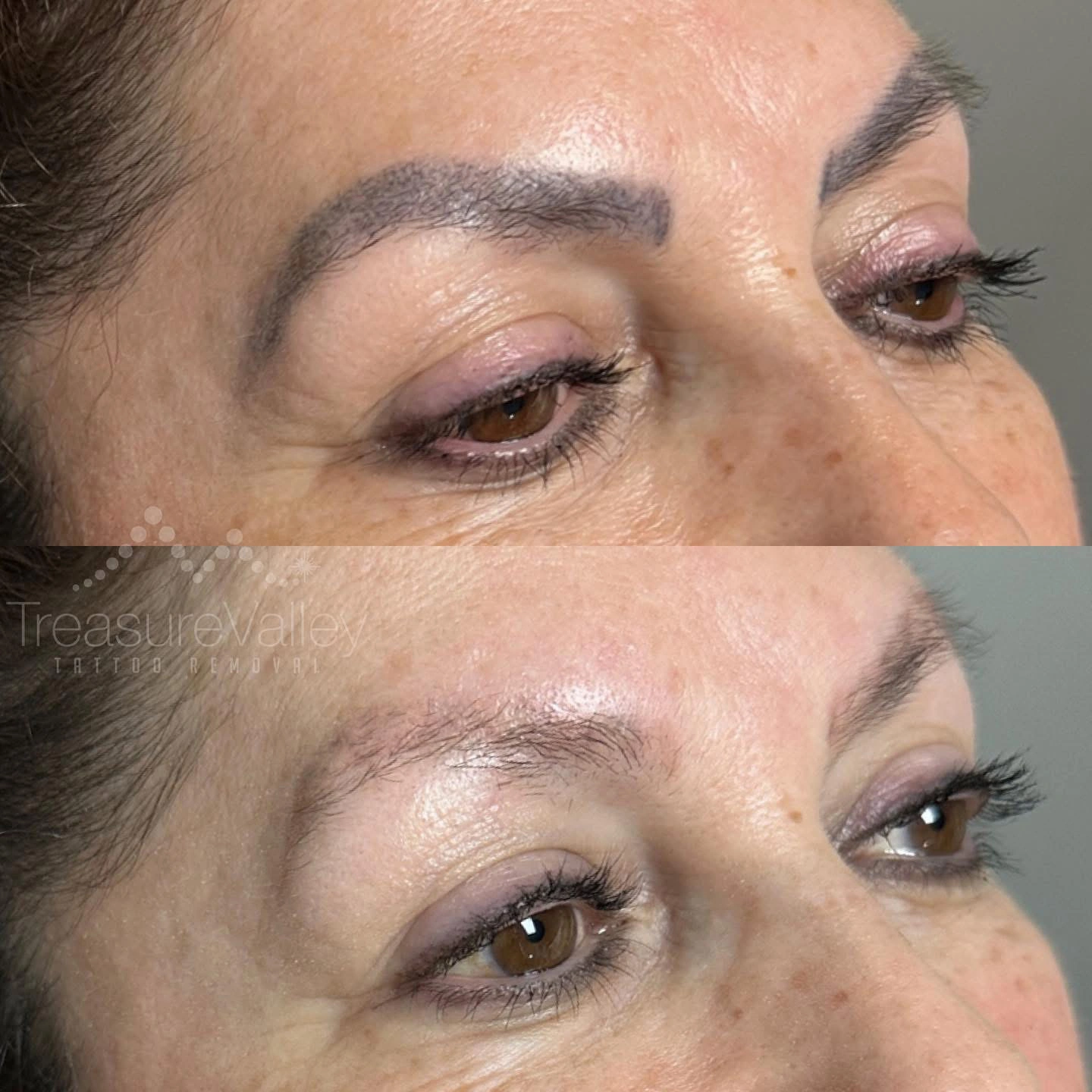 Permanent Cosmetic eyebrow removal Before and after brown eyes
