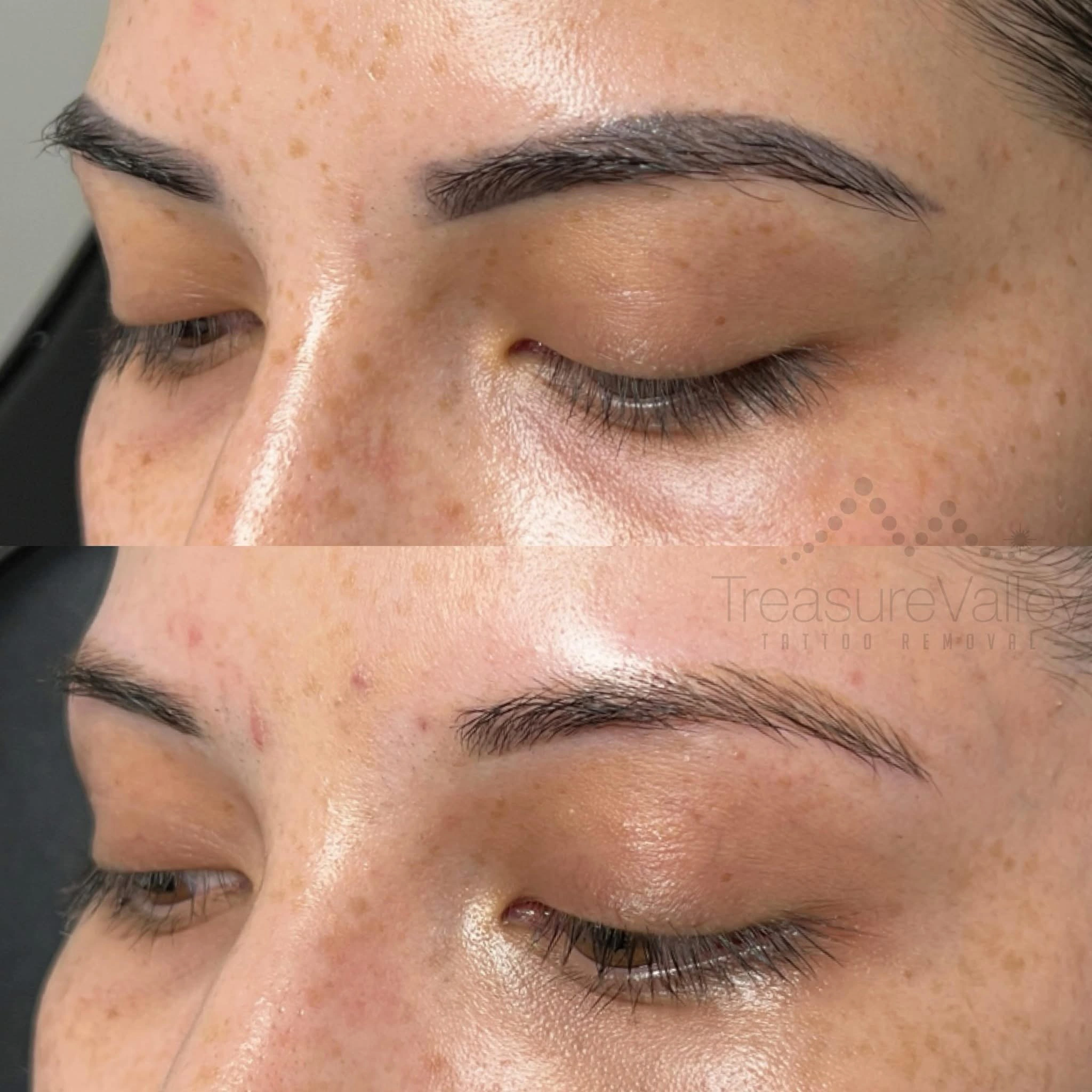 Permanent Cosmetic eyebrow removal Before and after closed eyes dark hair
