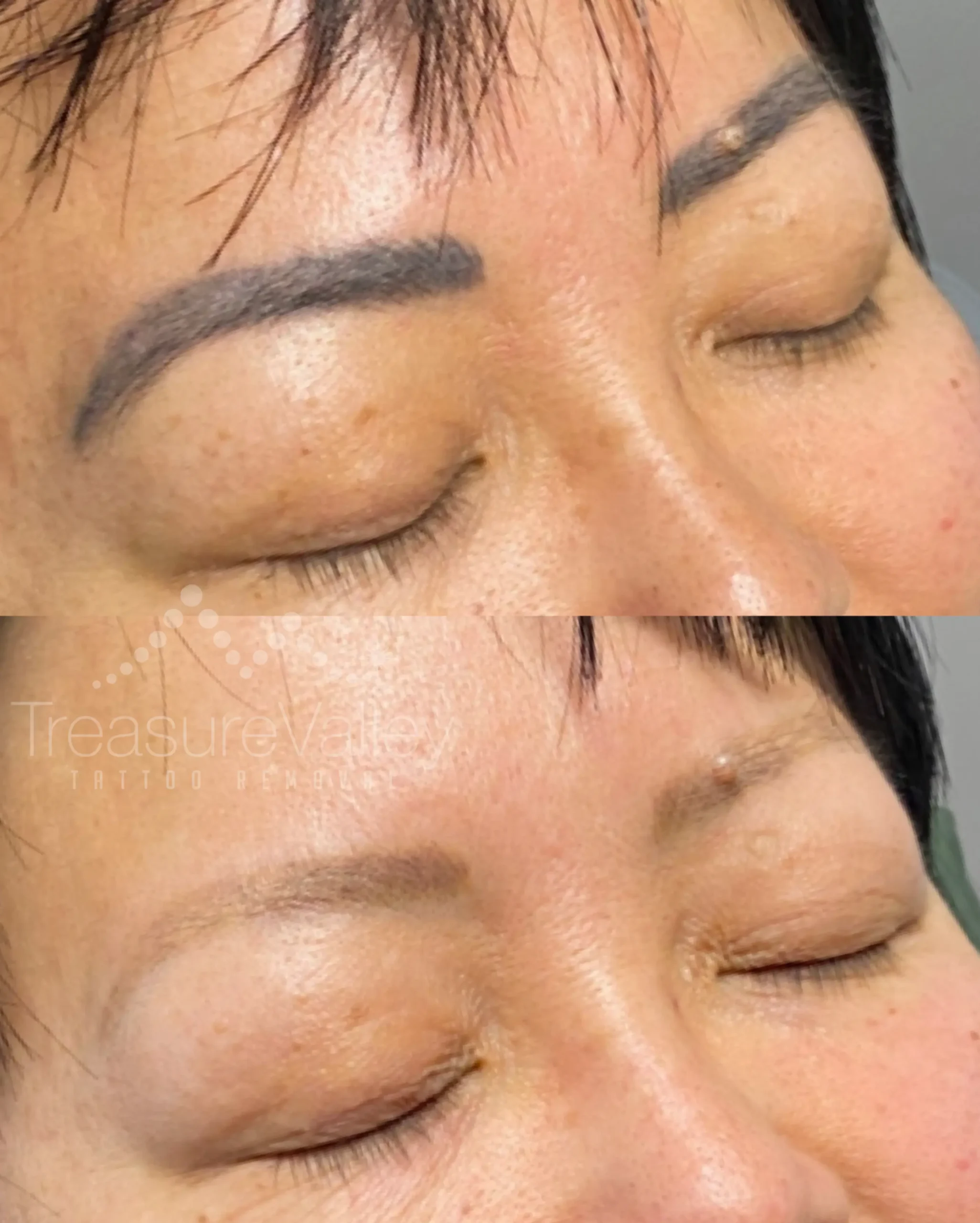 a photo of permanent eyebrow tattoo removal