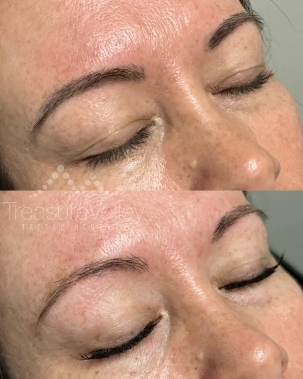 a photo of permanent eyebrow tattoo removal before and after